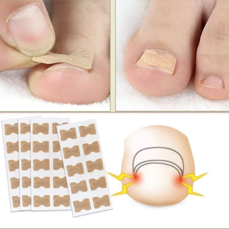 Nagelkorrektur Spange gegen eingewachsene Nägel | 10+10 GRATIS