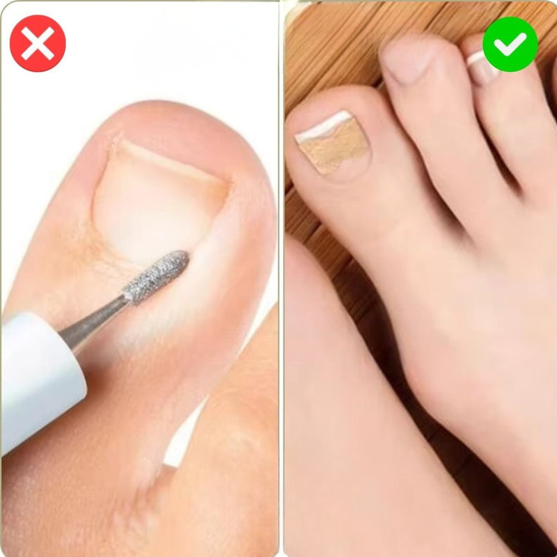 Nagelkorrektur Spange gegen eingewachsene Nägel | 10+10 GRATIS
