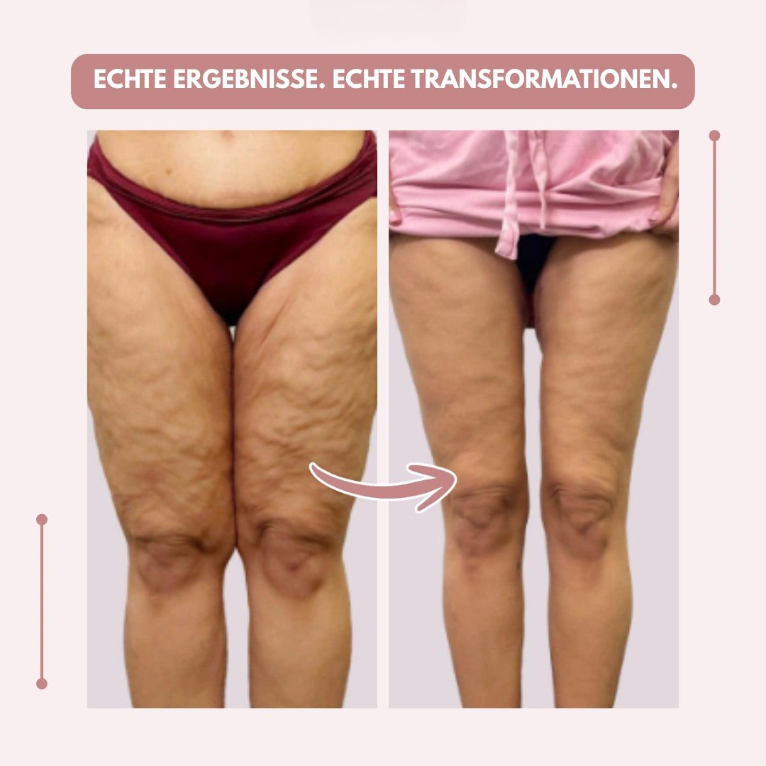 Kompressionsleggings mit hoher Taille | Lipödem schmerzen | FlexContour