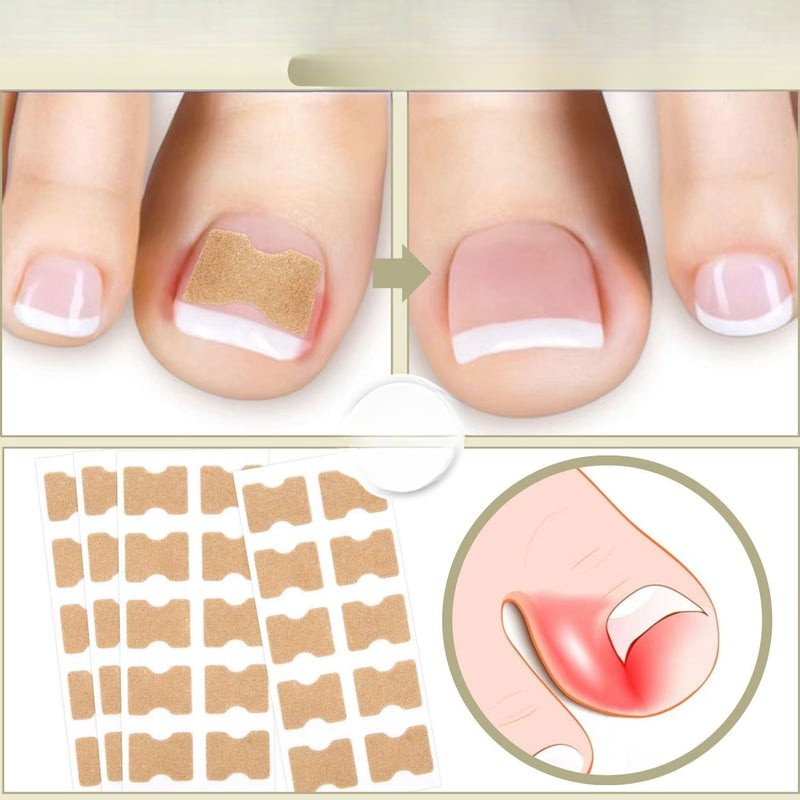 Nagelkorrektur Spange gegen eingewachsene Nägel | 10+10 GRATIS