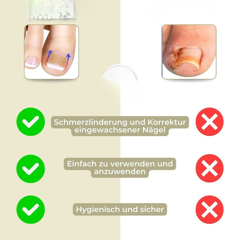 Nagelkorrektur Spange gegen eingewachsene Nägel | 10+10 GRATIS