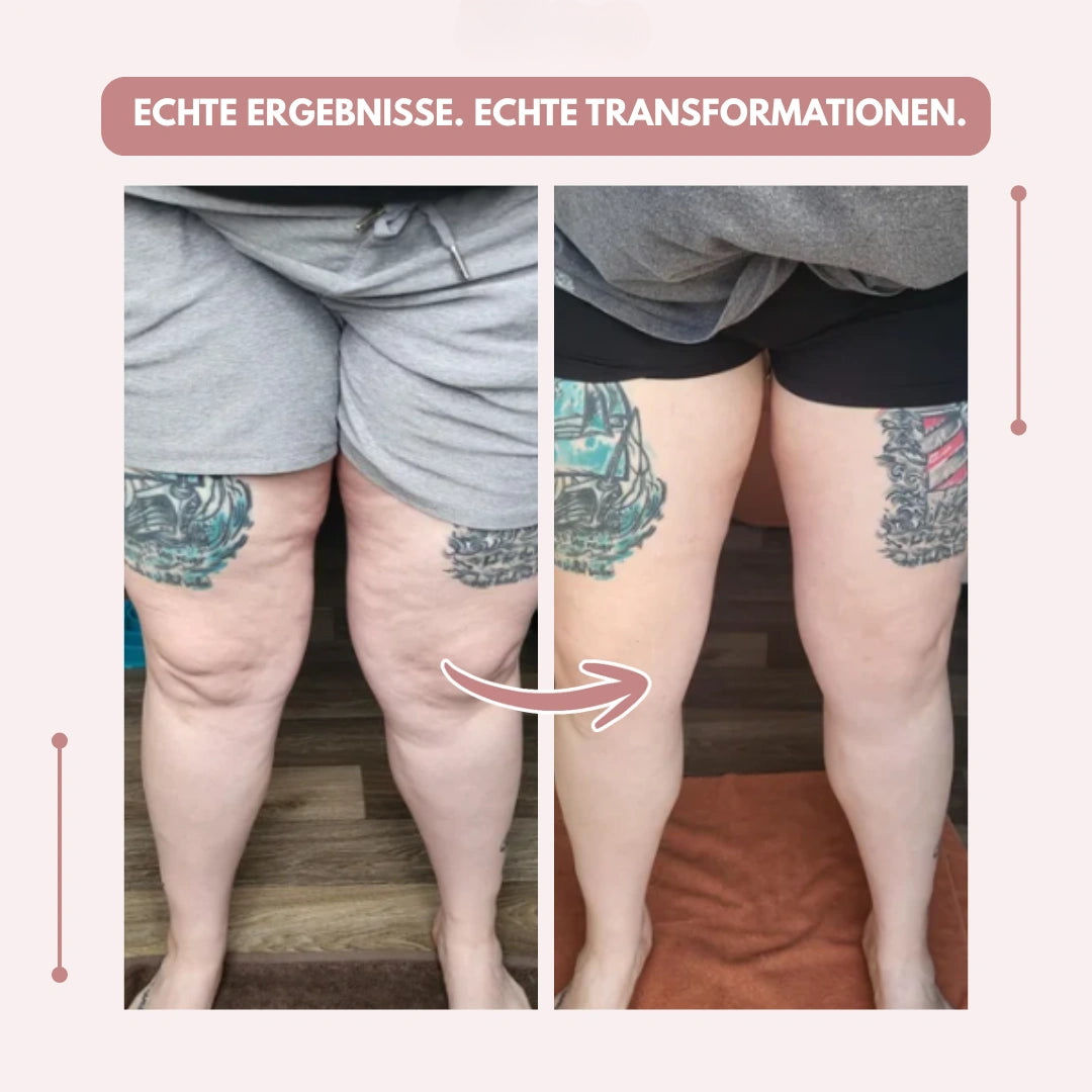 Kompressionsleggings mit hoher Taille | Lipödem schmerzen | FlexContour