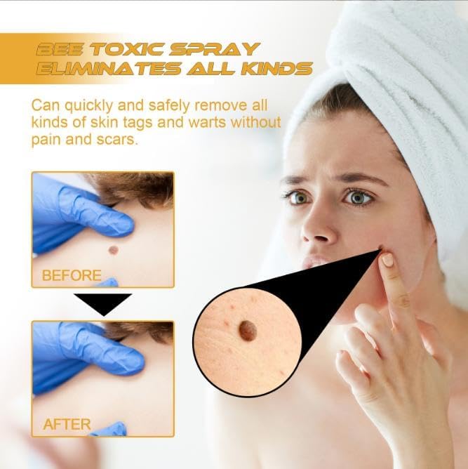 Warzenentferner | Zielgerichtetes Hautspray | Bienengift Pflegeformel | TagAway