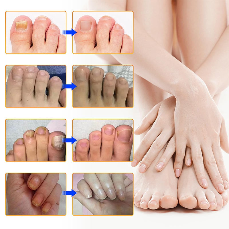 1+1 Gratis | Clear - Nagelpflege-Pflaster für die tägliche Anwendung